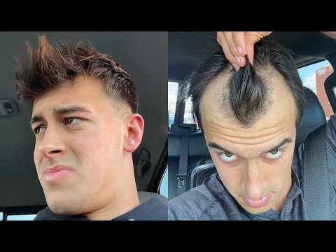 MY ENTIRE BALDING JOURNEY AGE 18 - 23