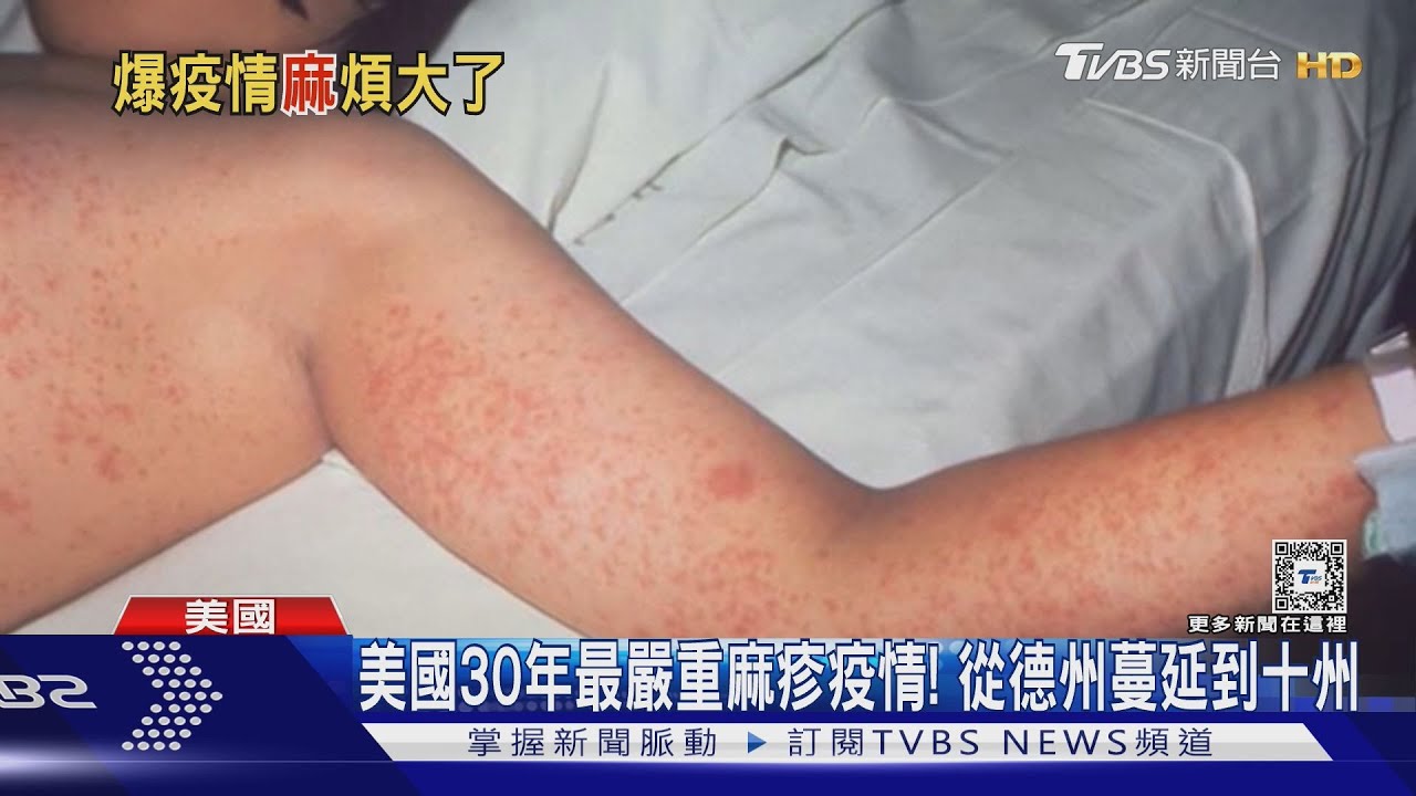 美麻疹疫情蔓延十州! 衛生部長「髮夾彎」挺打疫苗