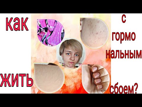 Как жить с гормональным сбоем?| Моя история| Аутоиммунный тереоидит| тереоидит| тереотоксикоз.