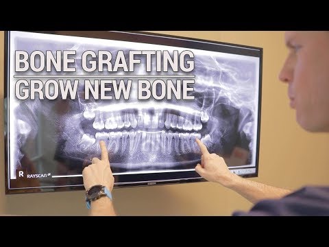 Dr. Pickup explains bone loss - do you have enough bone for dental implants?