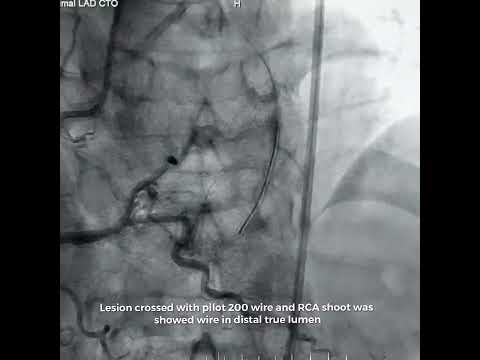 PTCA of Ostial LAD CTO