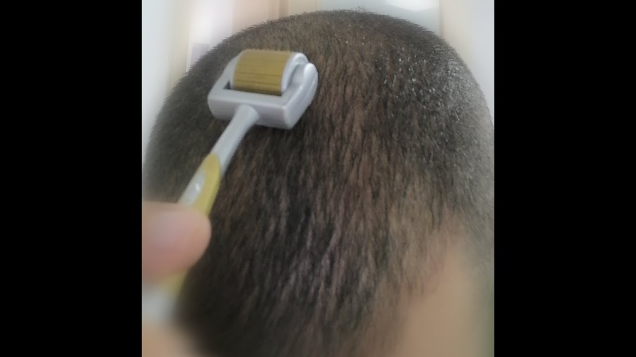 איך להשתמש בדרמה רולר להצמחת שיער?