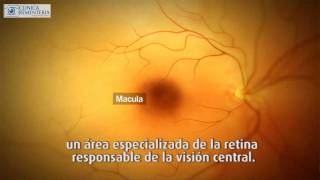 ¿Que es la Oclusión de Vasos Retinianos?