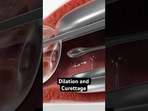 Collecting tissue from the uterus (3D Animation)