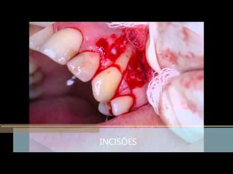 Cirurgias plásticas periodontais