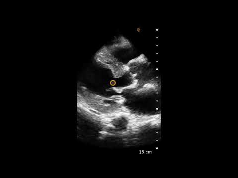 Concentric Left Ventricular Hypertrophy (LVH) - Ultrasound Image Interpretation