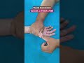 Thumb Examination Physiotherapy Hand Movement Advice Pain Finger Thumb Stiffness Bpi Mnd