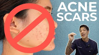 How to get rid of Acne Scars | Dr Davin Lim