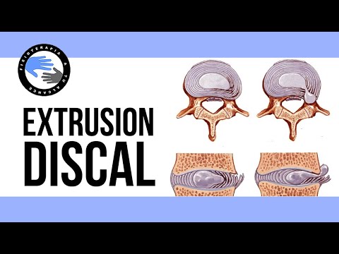 Extrusion discal ¿es realmente tan grave? que es y porque se produce