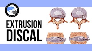 Extrusion discal ¿es realmente tan grave que es y porque se produce