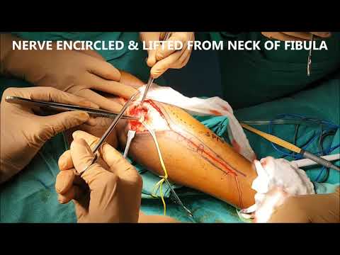 Excision of Head of Fibula for Ewing Sarcoma
