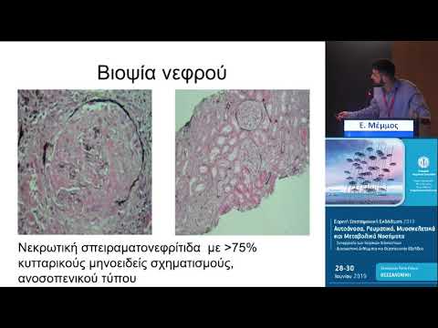 Μέμμος Ε. - Παρουσίαση Περισταστικού: ΑΝCA(+) αγγειίτιδα με πνευμονική και νεφρική συμμετοχή