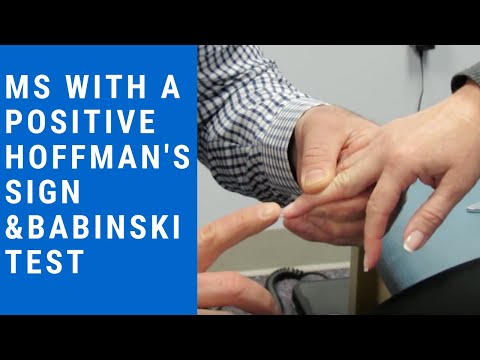 MS with positive Hoffman's sign and Babinski test