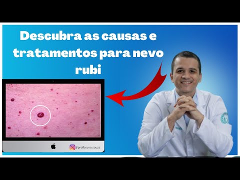 Como tratar e prevenir bolinhas vermelhas na pele (angioma rubi) - Conselhos de um dermatologista