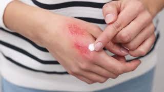 বার্ন ইনজুরিতে করণীয় ও যেসব ভুল একদমই করবেন না!