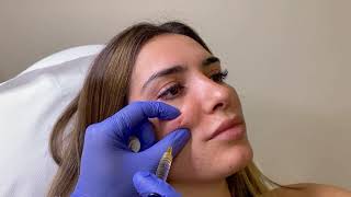 Corrección de Ojeras con Ácido Hialurónico