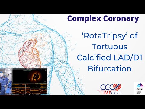 ‘RotaTripsy’ of Tortuous Calcified LAD/D1 Bifurcation