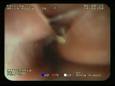 Controllare un fegato per parassiti Come sono a lungo trattati vermi