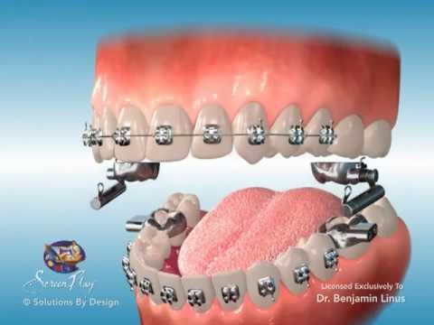 ScreenPlay Orthodontic Education Videos: AdvanSync Brackets