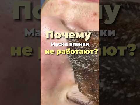 Film masks for blackheads don't work #blackheads #facemasks #acne #comedones
