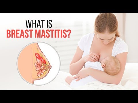 What is breast mastitis? Breast Infection | How can I tell if I have mastitis? Dr Nihar  Parekh