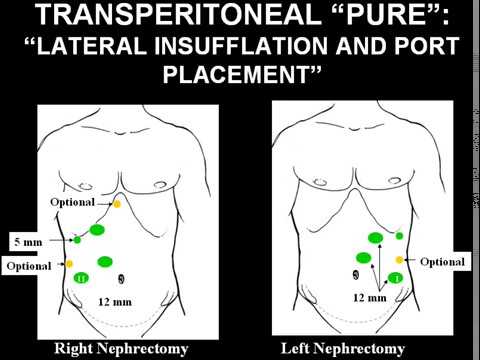 Laparoscopic Uro-Oncology: What is Going On?