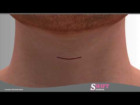 Anterior Cervical Discectomy and Fusion ACDF - Reno, Carson City, Nevada