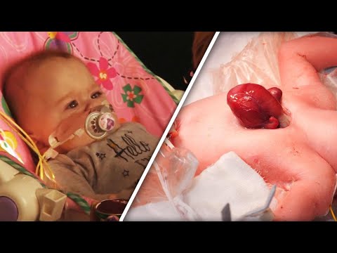 Baby Born With Heart Outside of Chest Allowed to Go Home