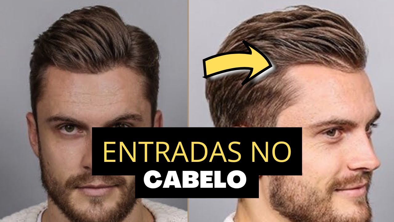 ENTRADAS NO CABELO: O QUE FAZER | DICAS DE CABELO