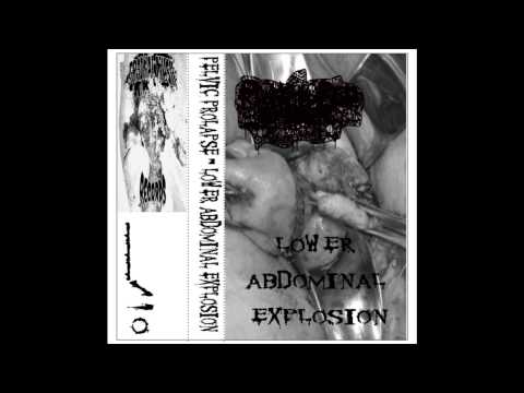 Pelvic Prolapse - Lower Abdominal Explosion (Demo)