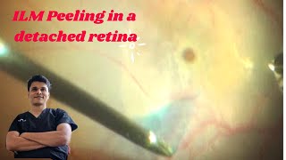 ILM peeling in detached retina