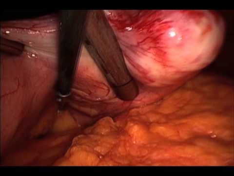 Gastric Schwannoma - Laparoscopic Wedge Resection