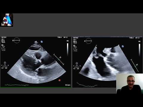 Dissection of Aorta vs Artifact