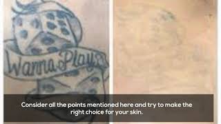 What Is The Best Method For Tattoo Removal?