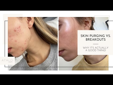 Skin Purging vs. Breakouts- What's the Difference?