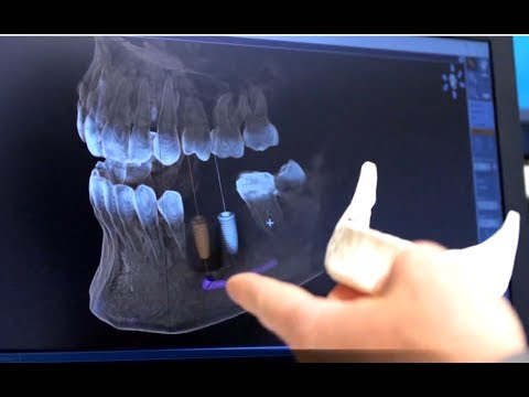 So funktioniert ein 3D-Röntgen ihrer Zähne (Digitale Volumentomographie, DVT)