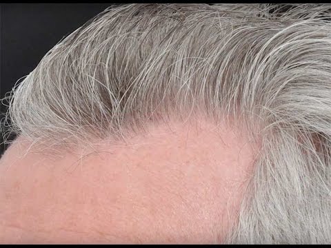 20 Years Hair Transplant Journey - Dr. Cole's Patient