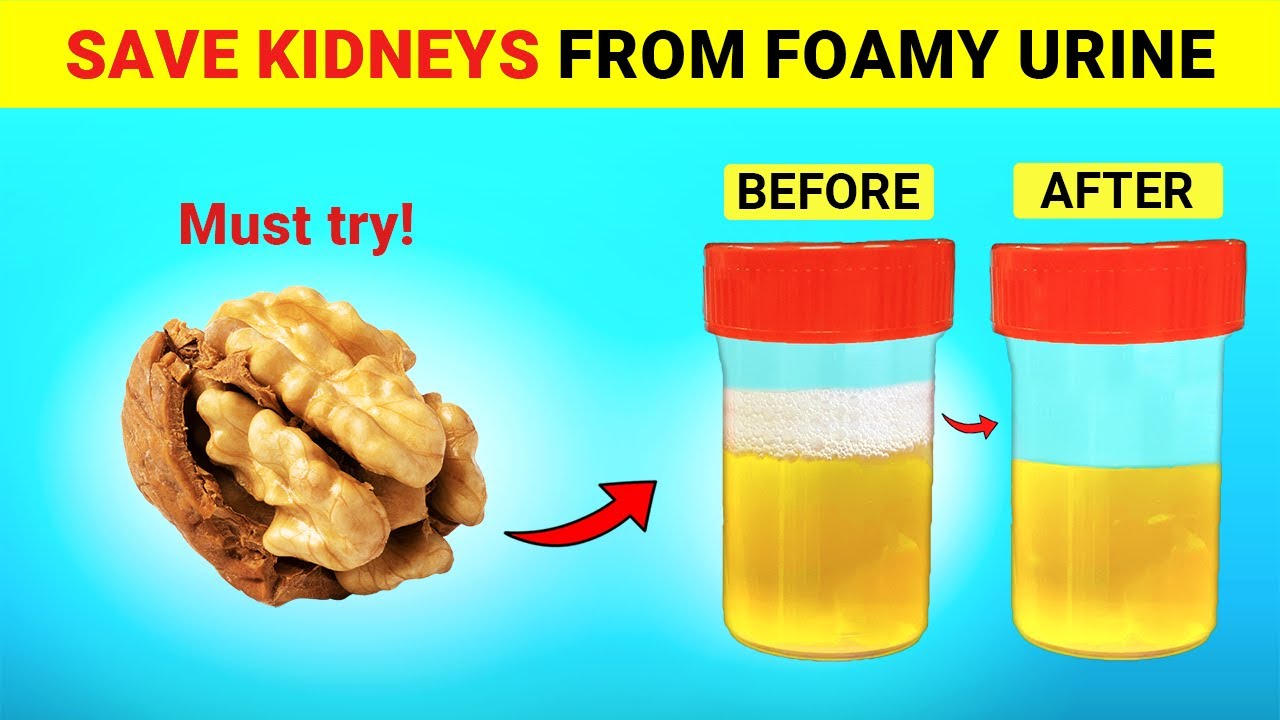 Top 6 Super Foods To Help Stop Proteinuria  and Heal Your Kidneys