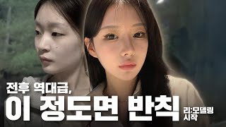 리;모델링ㅣ전후 공개 후 반응 폭발했던 모델의 비밀ㅣ비티성형외과