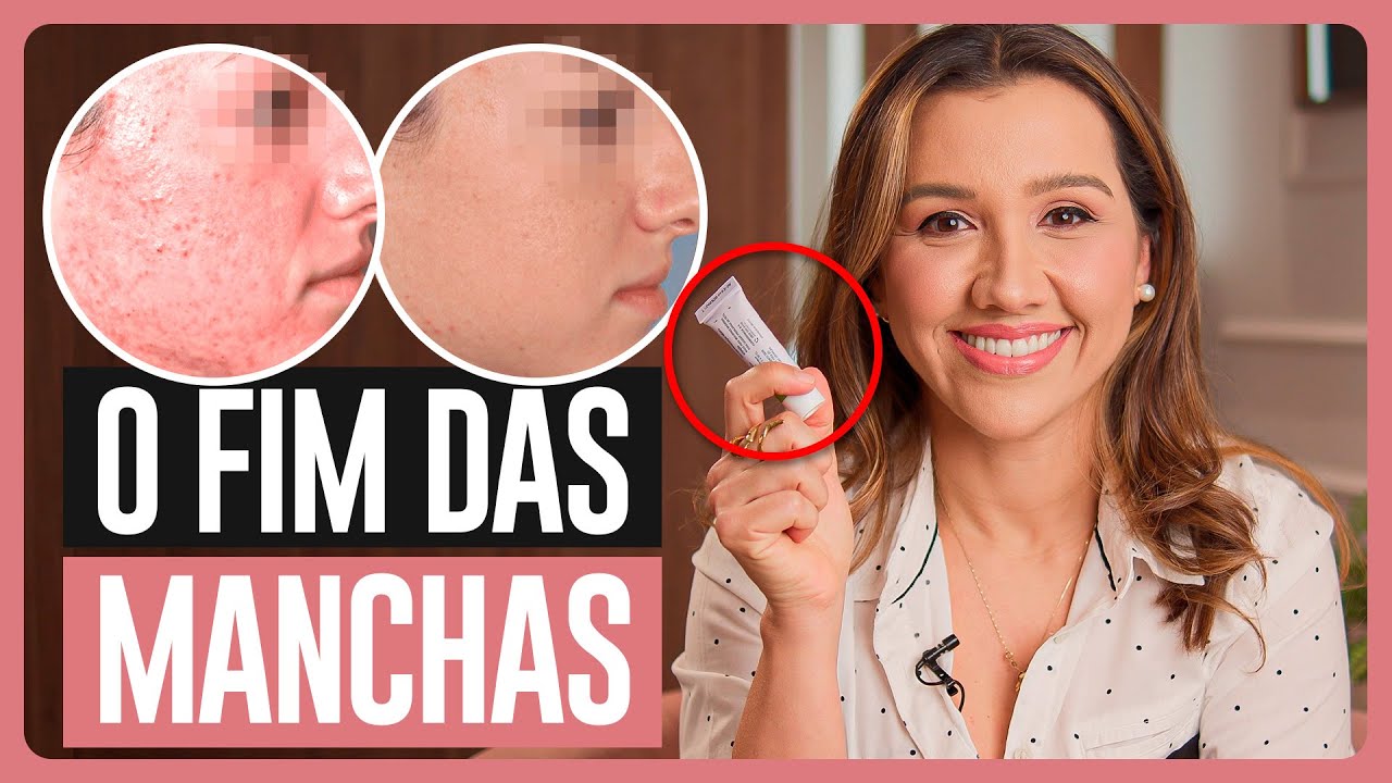 Como TIRAR MANCHAS de ACNE (espinhas) de FORMA EFICAZ (comece hoje mesmo)