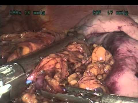 Laparoscopic Proximal Gastrectomy With Intracorporeal Circular Stapling Anastamosis For Gastric Cancer