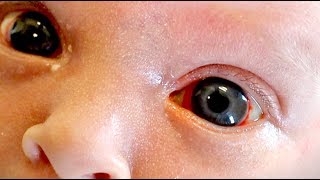 HELP! My Newborn Has Blood in the White of His Eyes (Subconjunctival Hemorrhage)