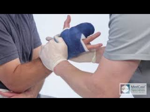 How to apply a RADIAL GUTTER Cast - Plus Cast Removal