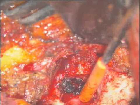 posterior cervical foraminotomy discectomy