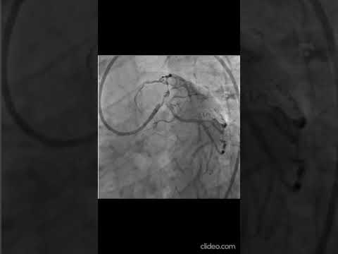 Left Main Angioplasty  by T Stenting  Technique  AIIMS Bhubaneswar