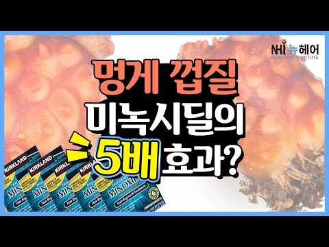 멍게 껍질이 미녹시딜 5배의 탈모치료 효과가 있다? - 뉴헤어 I 모발이식 I 탈모QnA I