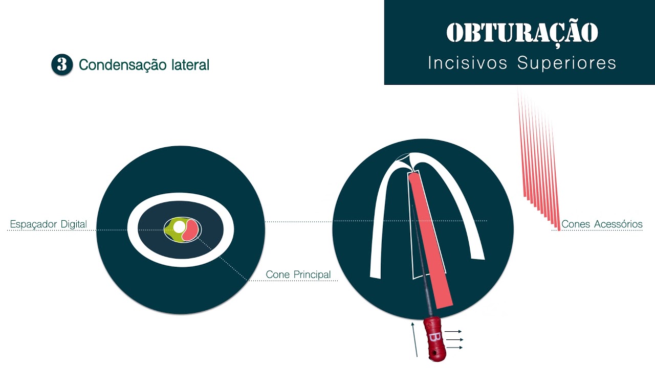 Técnica de obturação do canal radicular