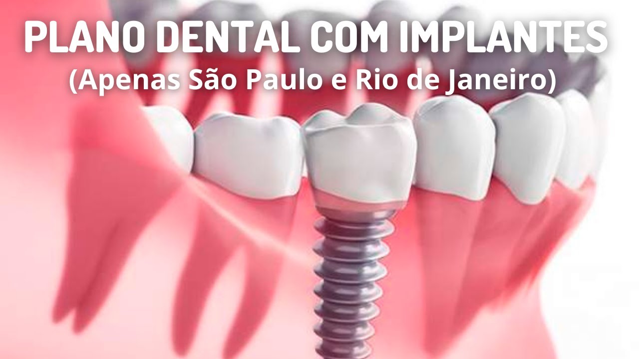 Plano Odontológico que cobre Implantes Dentários