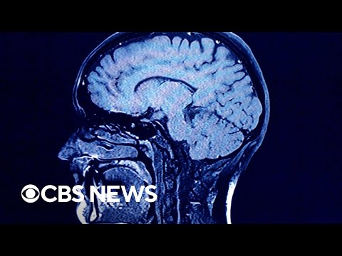 What happens to our brains when we die? A new study could provide answers