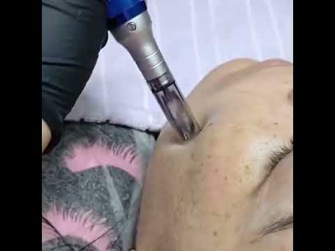 microagulhamento facial em pauliceia são Bernardo do campo são paulo